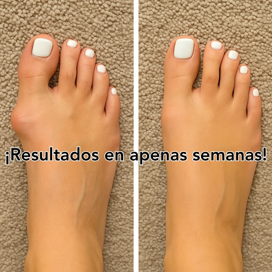 Corrector de Juanetes FlexToe | Alivia y recupera tus hermosos pies en semanas